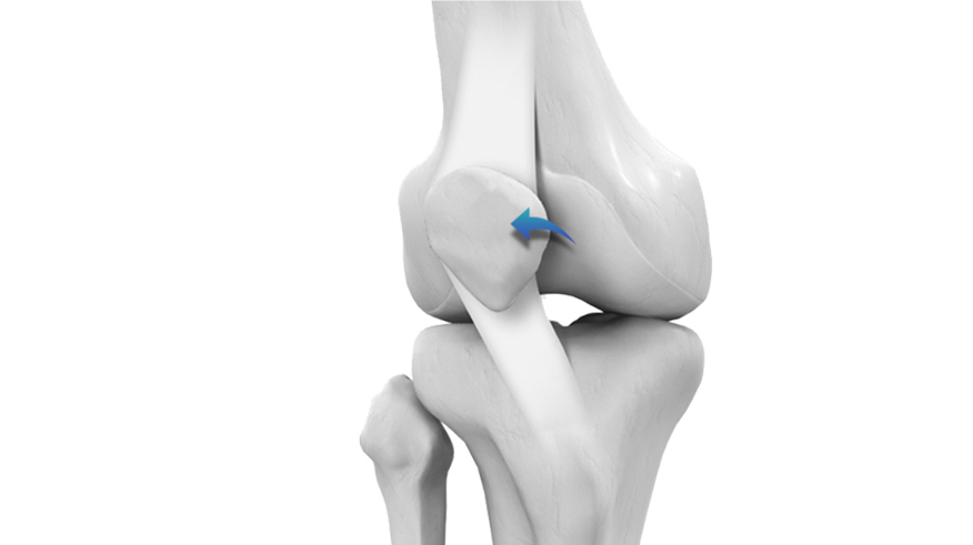Knee Related Sports Injuries